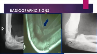RADIOGRAPHIC SIGNS
 