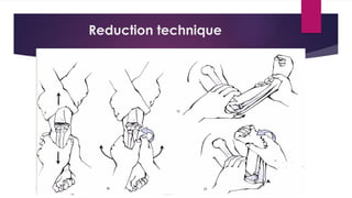 Reduction technique
 