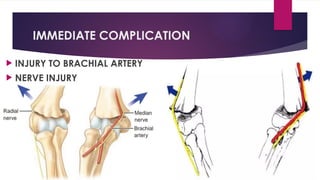 IMMEDIATE COMPLICATION
 INJURY TO BRACHIAL ARTERY
 NERVE INJURY
 