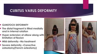 CUBITUS VARUS DEFORMITY
 GUNSTOCK DEFORMITY
 The distal fragment is tilted medially
and in internal rotation
 Hyper extension at elbow along with
limitation of flexion
 Mild deformity –No treatment
 Severe deformity –Corrective
osteotomy(French osteotomy)
 