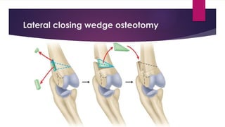 Lateral closing wedge osteotomy
 