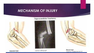 MECHANISM OF INJURY
 