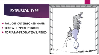 EXTENSION TYPE
 FALL ON OUTSTRECHED HAND
 ELBOW –HYPEREXTENDED
 FOREARM-PRONATED/SUPINED
 