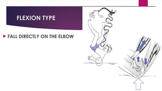 FLEXION TYPE
 FALL DIRECTLY ON THE ELBOW
 