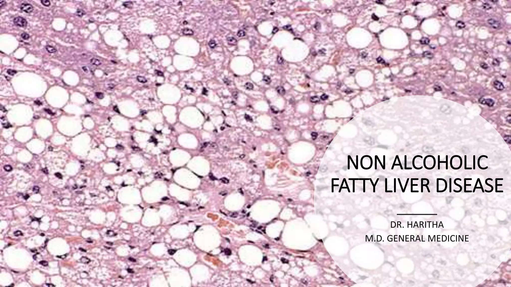 NON ALCOHOLIC FATTY LIVER DISEASE | PPTX