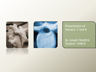 Presentation of
thoracic 7 and 8
By Joseph Reddick
Student 155810
 