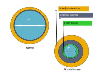 Muscle contraction
Mucosal oedema
Sticky mucus
R2
R2
Bronchitis case
Normal
9/25/20135
 
