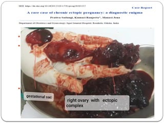  Pelvic CT—10*8cm rt tubo-ovarian mass (sugestive of CEP)
 Exploratory laparotomy done
 small bowel adhesion to cystic mass in rt FT along with rt
ovary,that densely adher to posterior surface of Ux
 entire complet with tube and ovary removed with Rt
salphingoophorectomy
 Histo-pathologic result showed a dilated FT containing blood clot and
trophoblast along with fibrin rich infarcted and viable chorionic villi,
confirming the diagnosis of ectopic pregnancy.
 