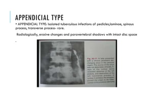Tuberculosis of lumbosacral spine and hip | PPTX