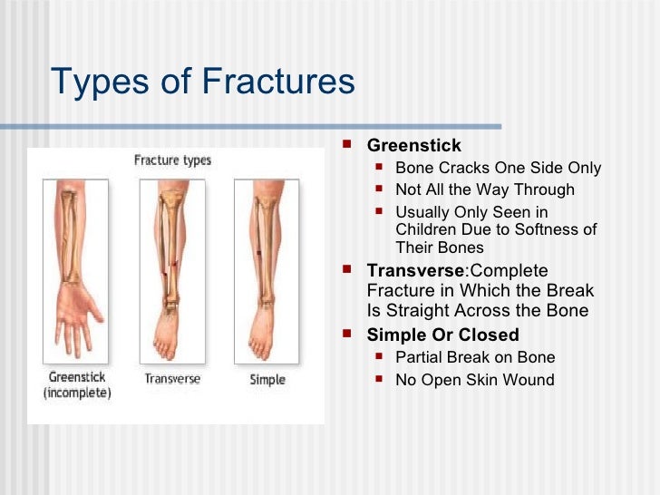 Presentation2 Fractures