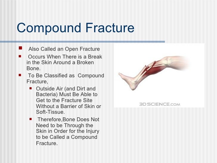 compound fracture