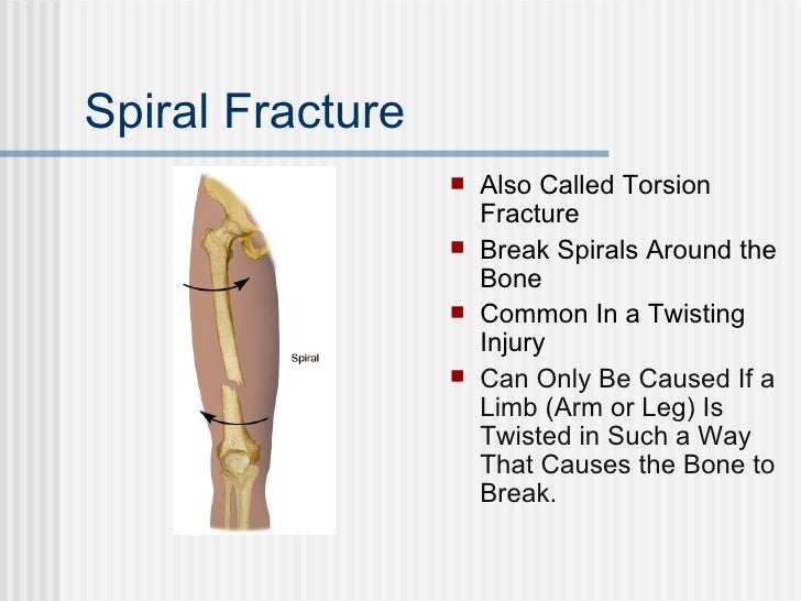 Presentation2 Fractures