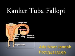 Kanker Tuba Fallopi
 