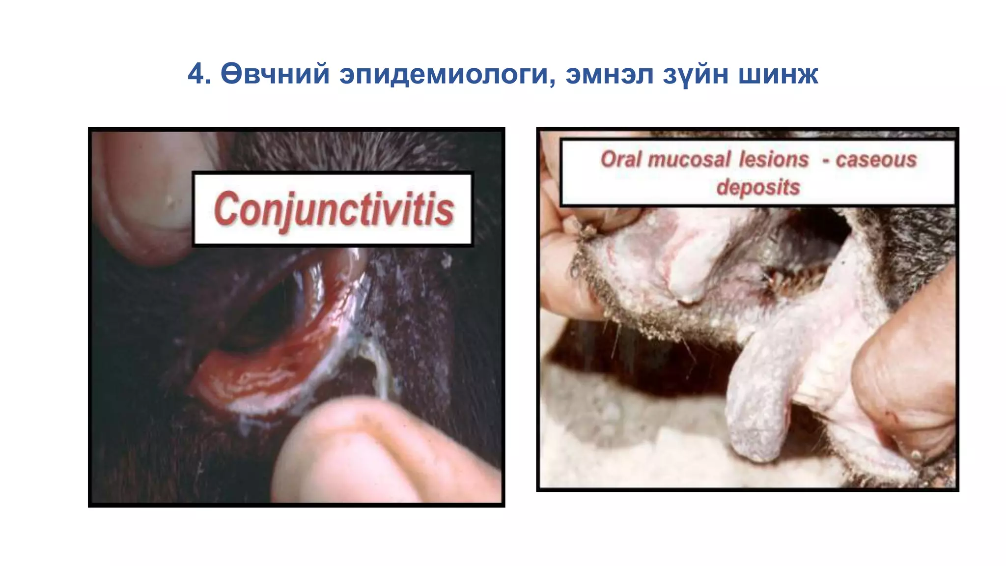 4. Өвчний эпидемиологи, эмнэл зүйн шинж
 