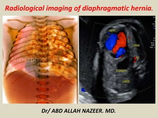 Radiological imaging of diaphragmatic hernia.
Dr/ ABD ALLAH NAZEER. MD.
 