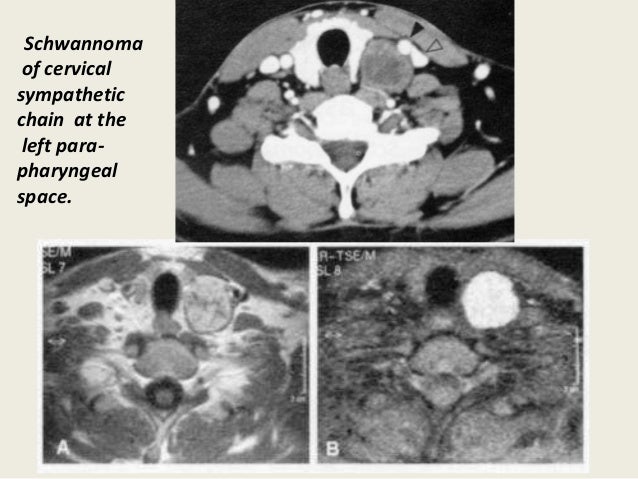 Presentation2, radiological imaging of neck schwannoma.