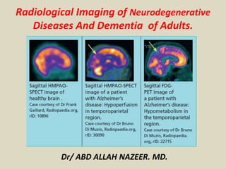 Radiological Imaging of Neurodegenerative
Diseases And Dementia of Adults.
Dr/ ABD ALLAH NAZEER. MD.
 