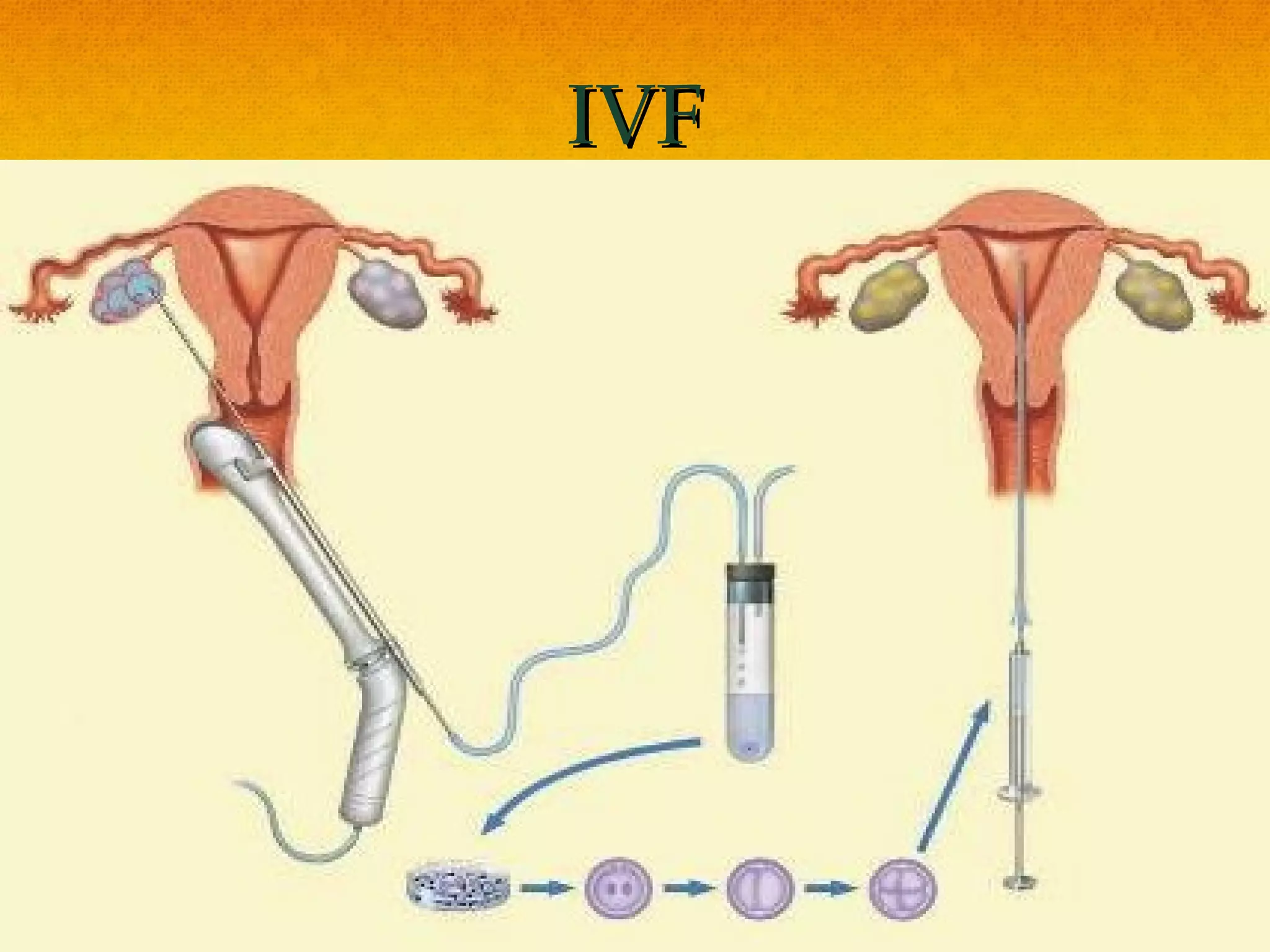 IVF
 