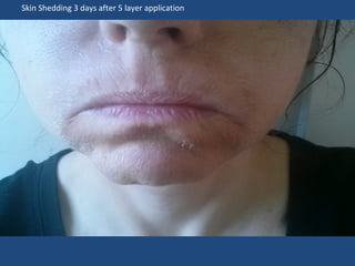 Skin Shedding 3 days after 5 layer application
 