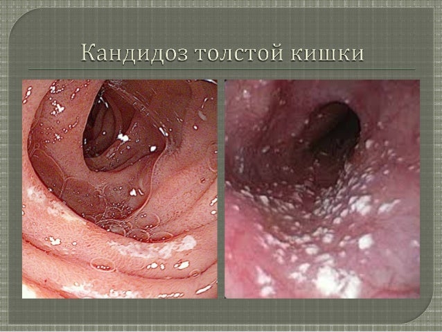 ГЕМОРРОЙ ПРИЧИНЫ ЛЕЧЕНИЕ ПРОФИЛАКТИКА. АНАЛЬНЫЙ ЗУД