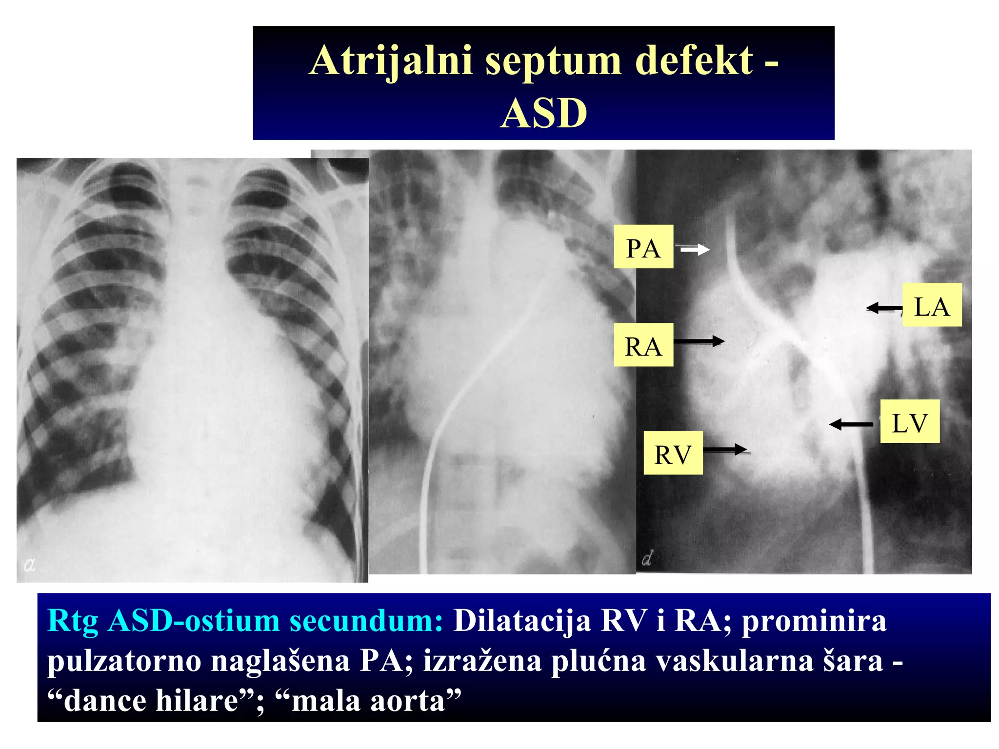 Atrijalni septum defekt -
ASD
Rtg ASD-ostium secundum: Dilatacija RV i RA; prominira
pulzatorno naglašena PA; izražena plućna vaskularna šara -
“dance hilare”; “mala aorta”
RV
RA
PA
LV
LA
 