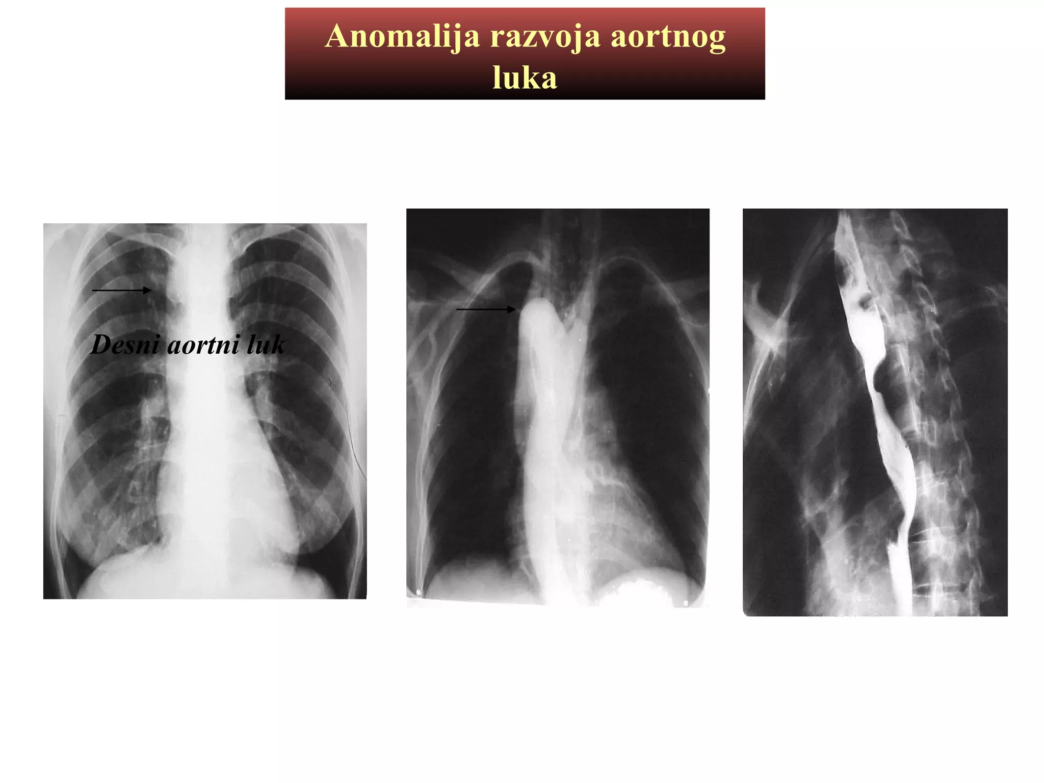Anomalija razvoja aortnog
luka
Desni aortni luk
 