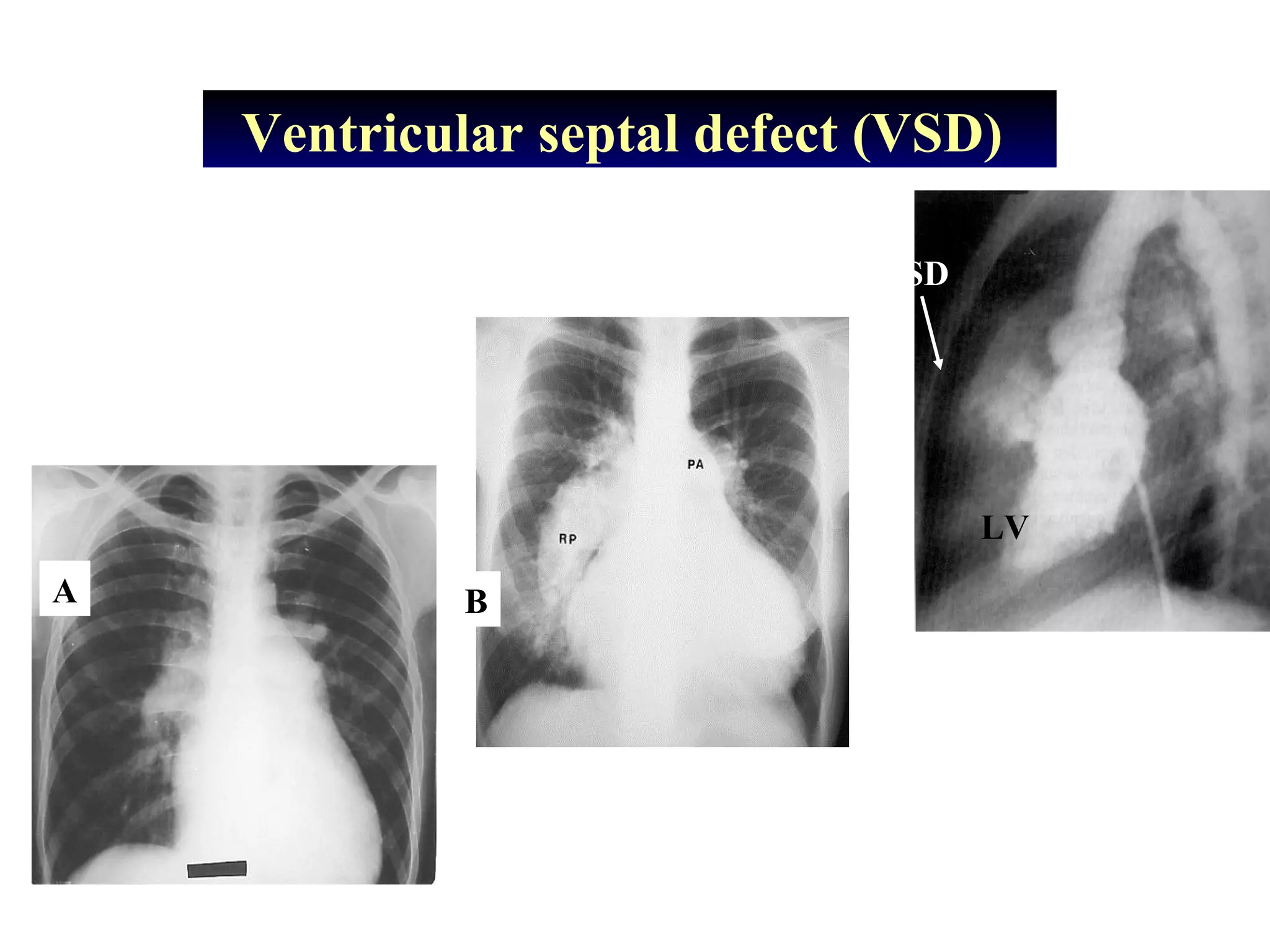 Ventricular septal defect (VSD)
RV
VSD
LV
A B
 