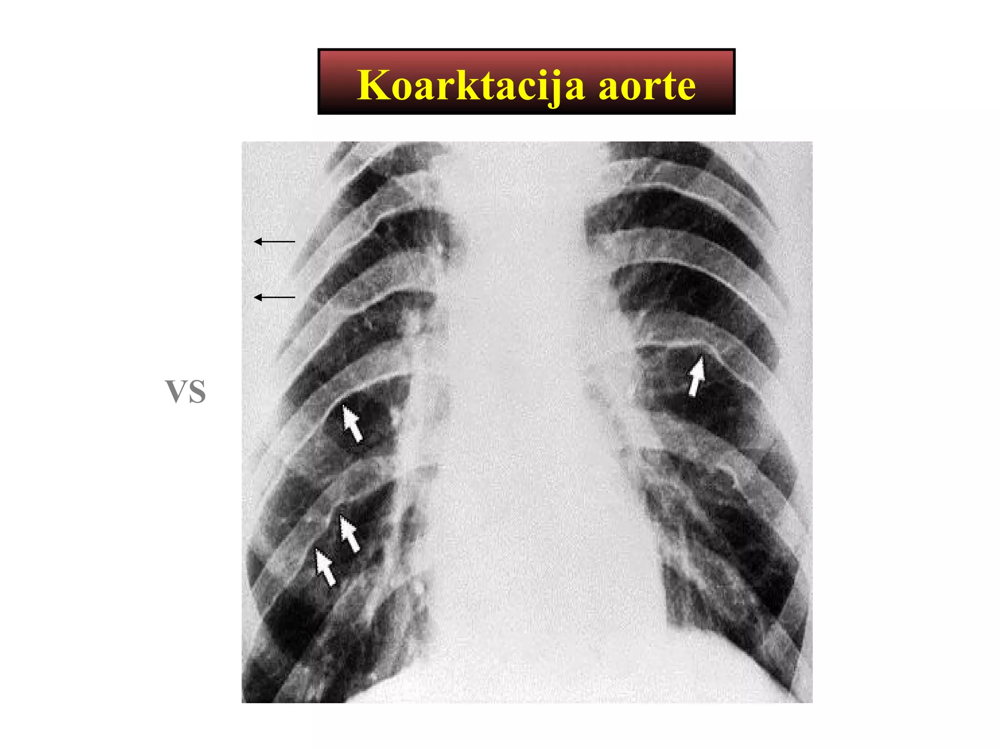 Koarktacija aorte
VS
 