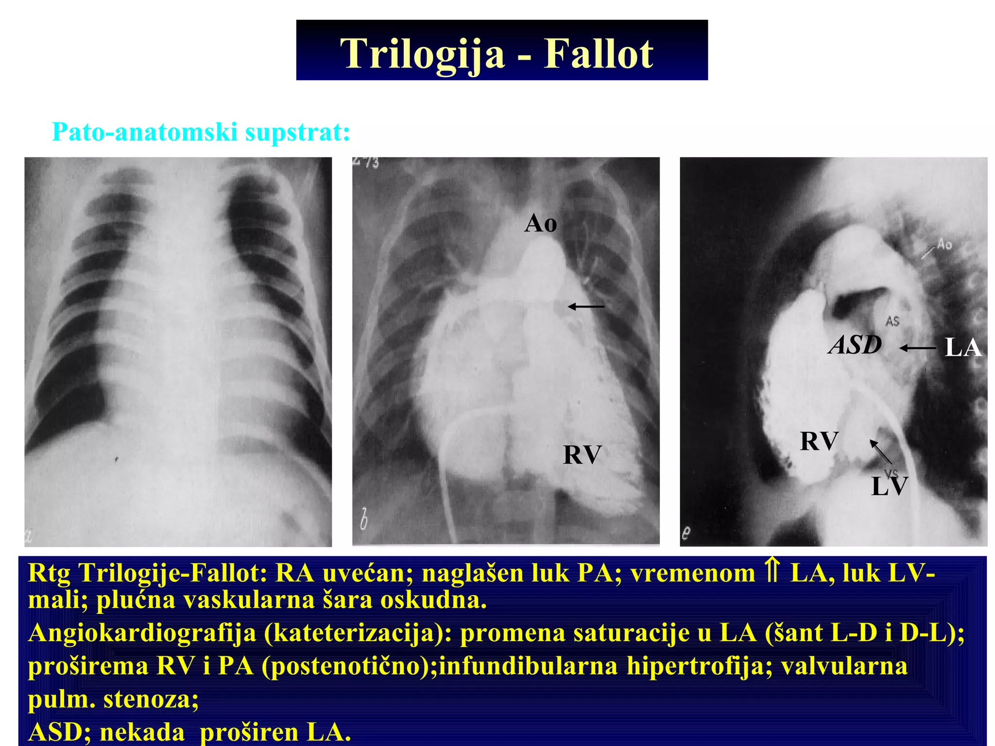 Trilogija - Fallot
Pato-anatomski supstrat: valvularna (ili subvalvularna) stenoza PA; ASD;
hipertrofija VD;
Rtg Trilogije-Fallot: RA uvećan; naglašen luk PA; vremenom ⇑ LA, luk LV-
mali; plućna vaskularna šara oskudna.
Angiokardiografija (kateterizacija): promena saturacije u LA (šant L-D i D-L);
proširema RV i PA (postenotično);infundibularna hipertrofija; valvularna
pulm. stenoza;
ASD; nekada proširen LA.
RVRV
Ao
ASD
LV
LA
 