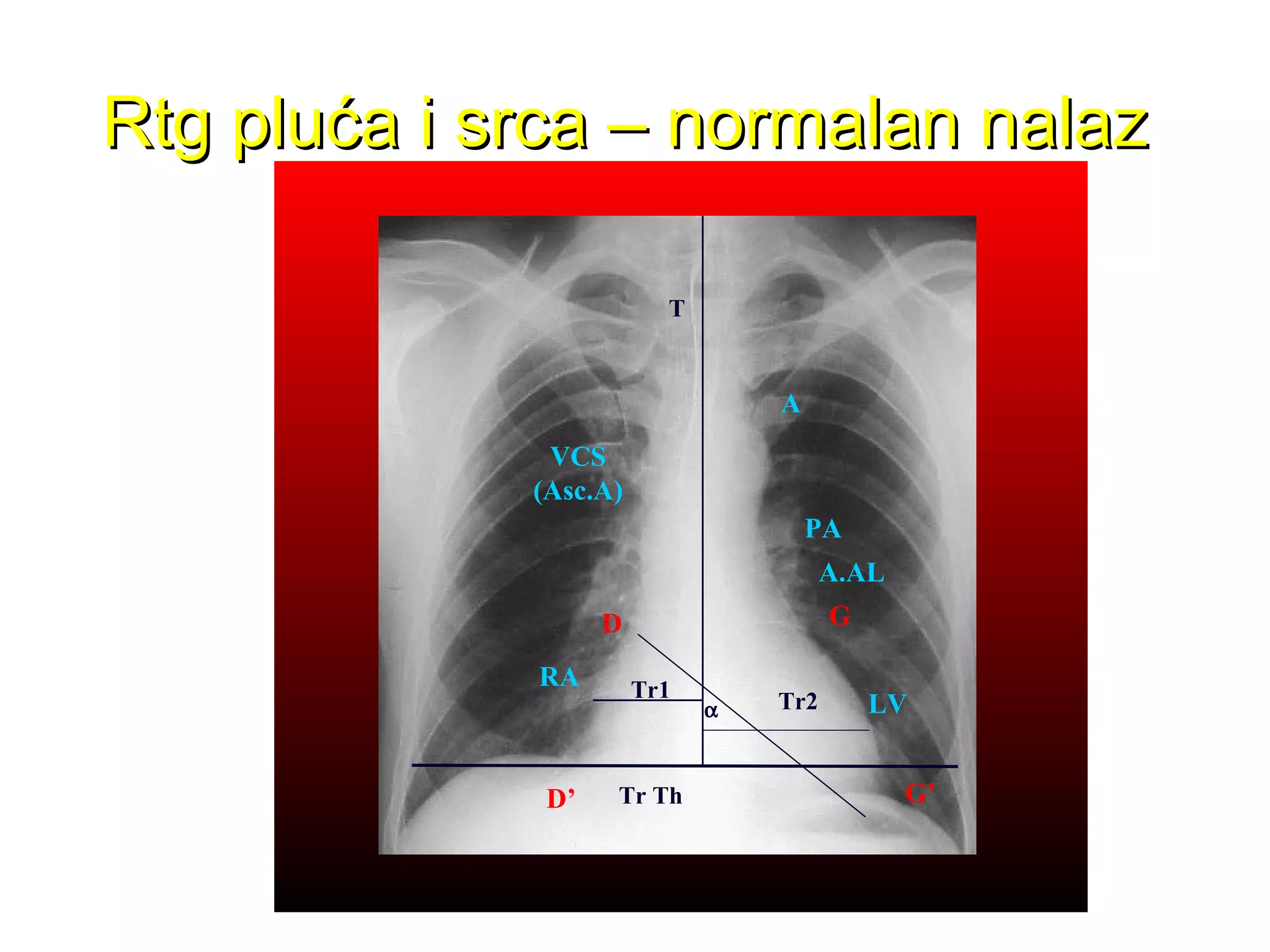 D’
D G
G’
α Tr2Tr1
Tr Th
RA
VCS
(Asc.A)
T
A
PA
A.AL
LV
Rtg pluća i srca – normalan nalazRtg pluća i srca – normalan nalaz
 