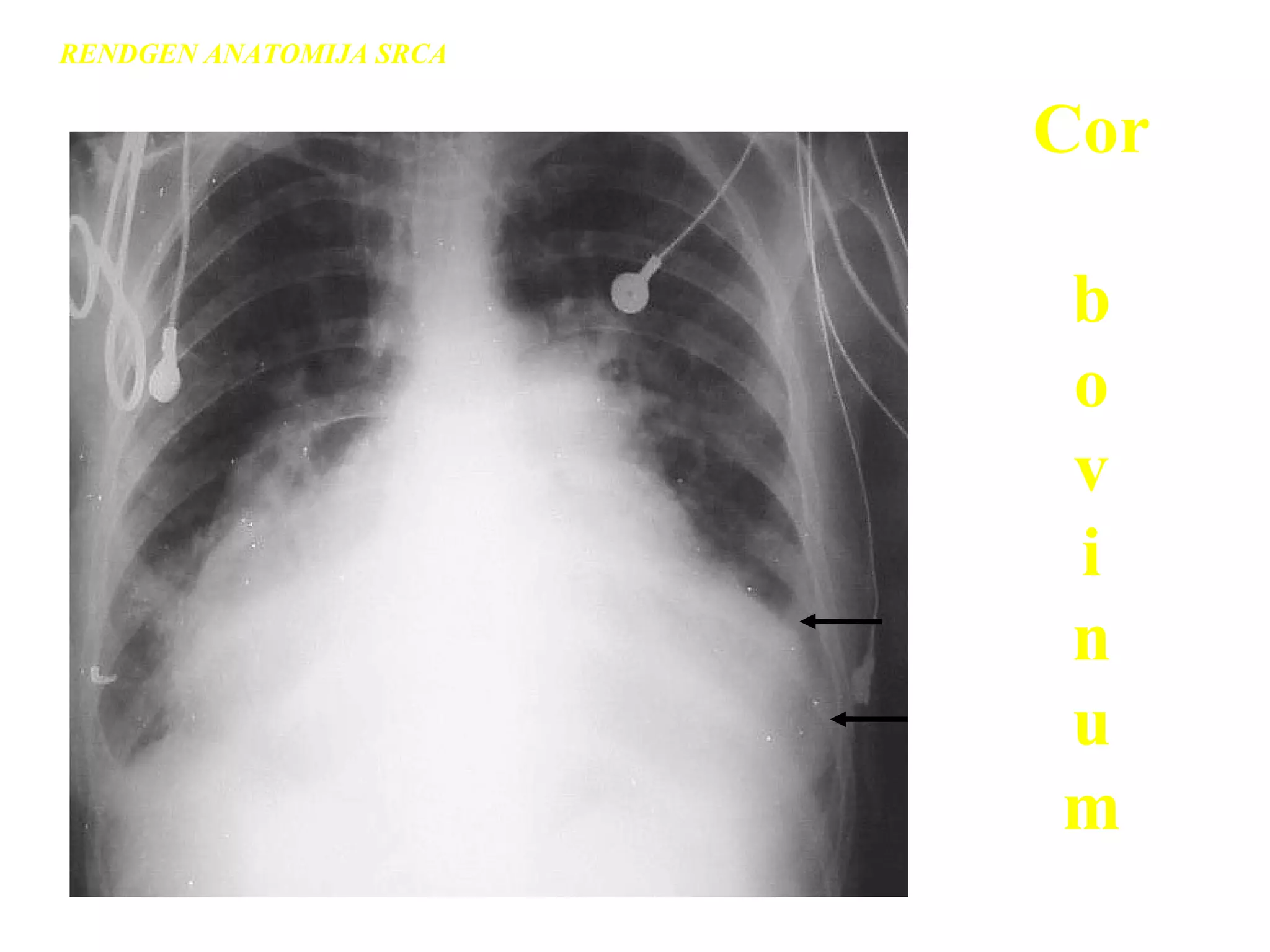 Cor
b
o
v
i
n
u
m
RENDGEN ANATOMIJA SRCA
 