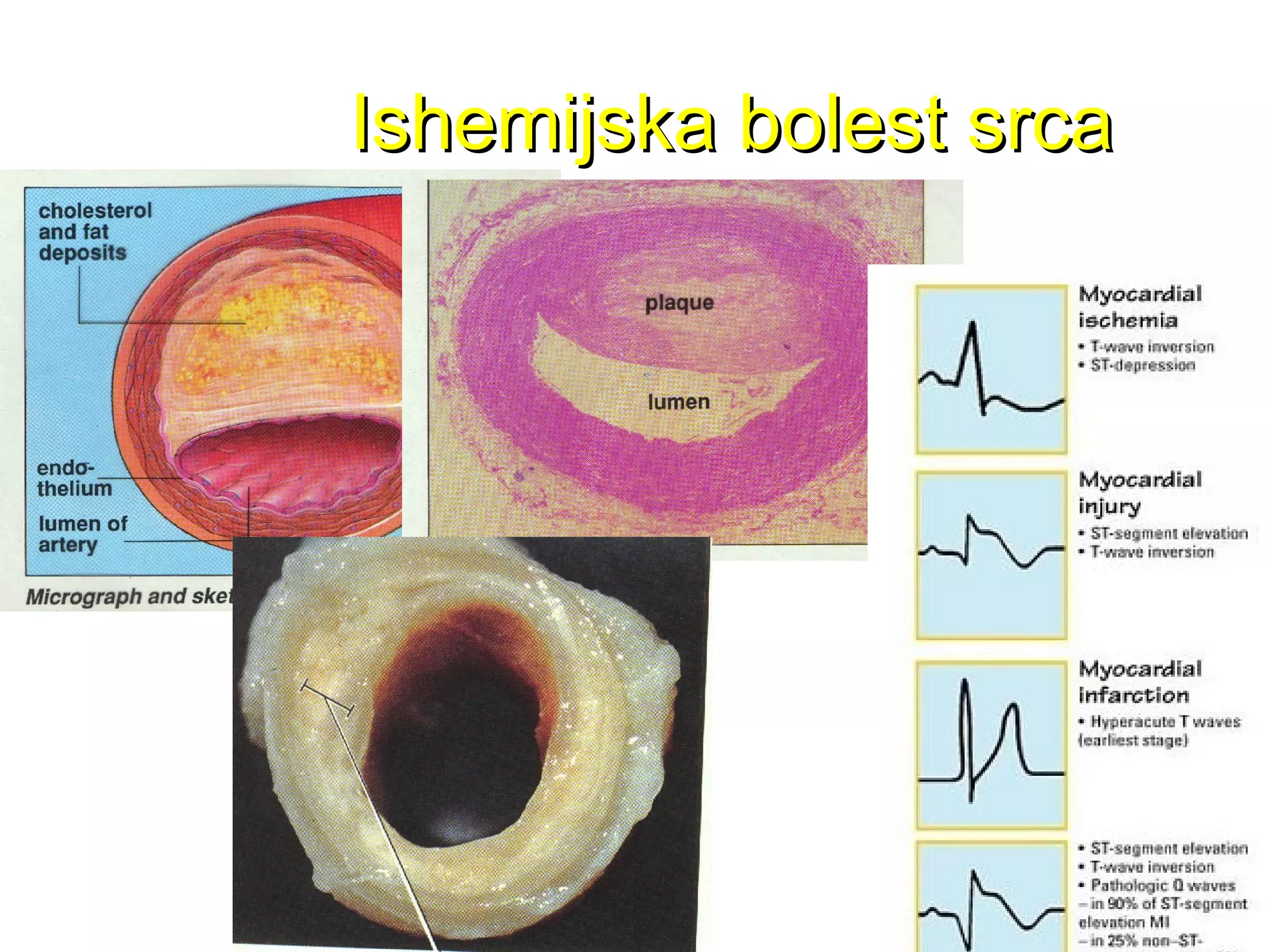 Ishemijska bolest srcaIshemijska bolest srca
 