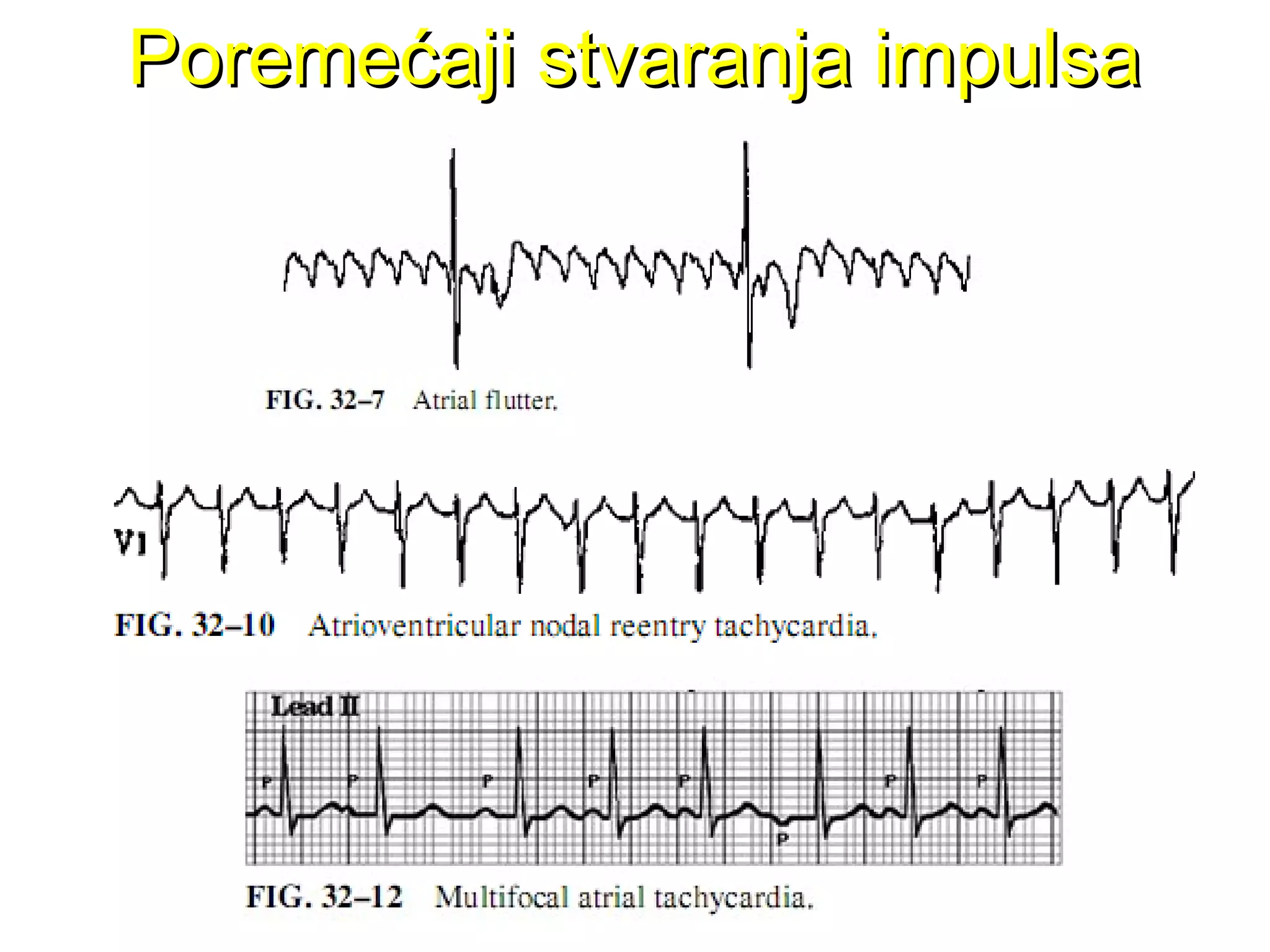 Poremećaji stvaranja impulsaPoremećaji stvaranja impulsa
 