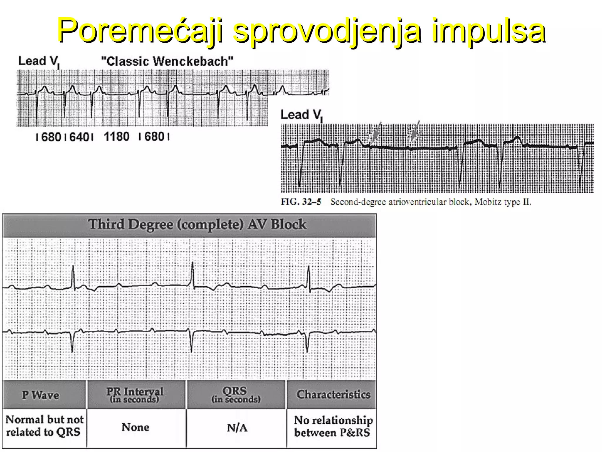 Poremećaji sprovodjenja impulsaPoremećaji sprovodjenja impulsa
 