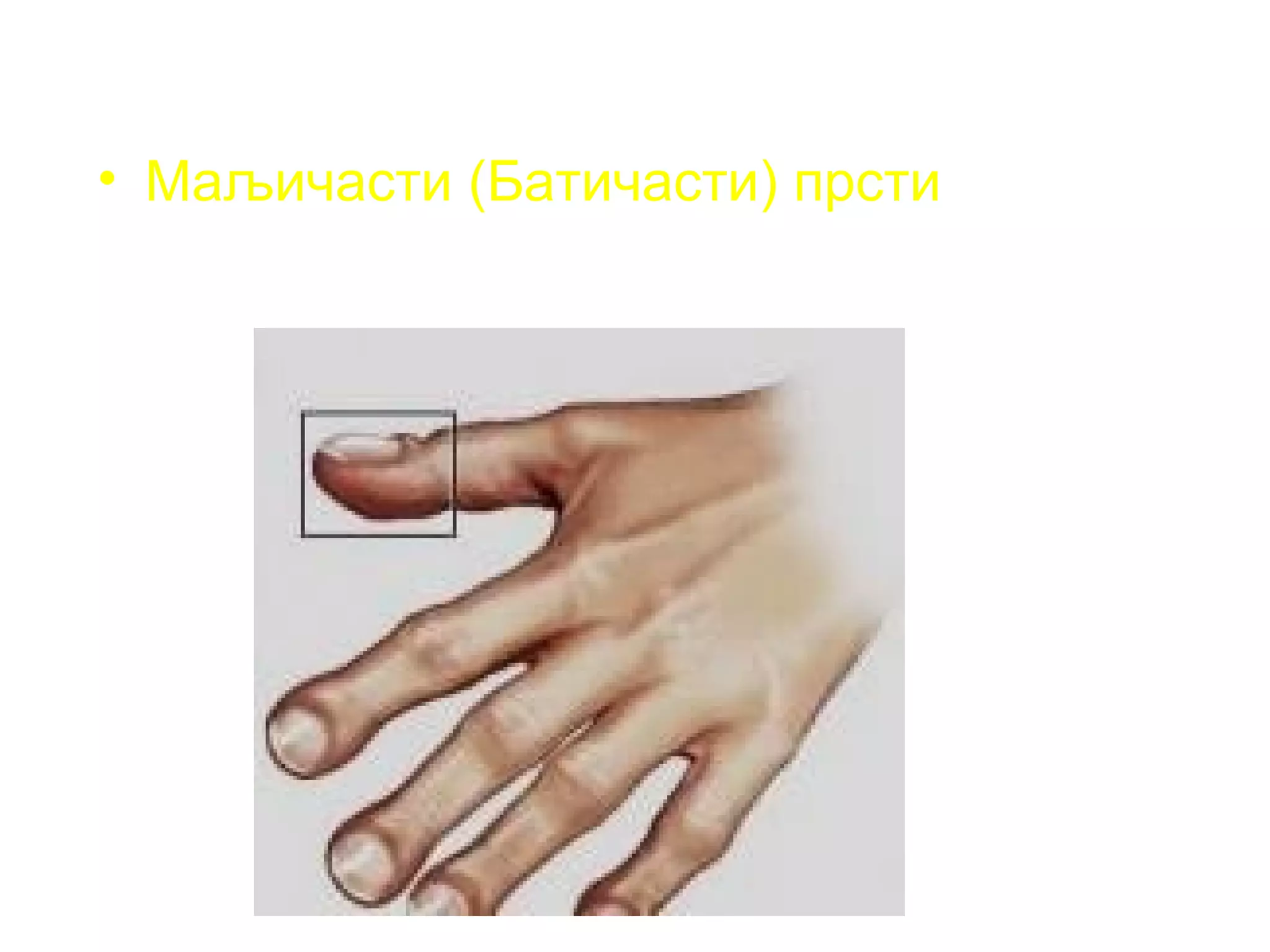 • Маљичасти (Батичасти) прсти
 