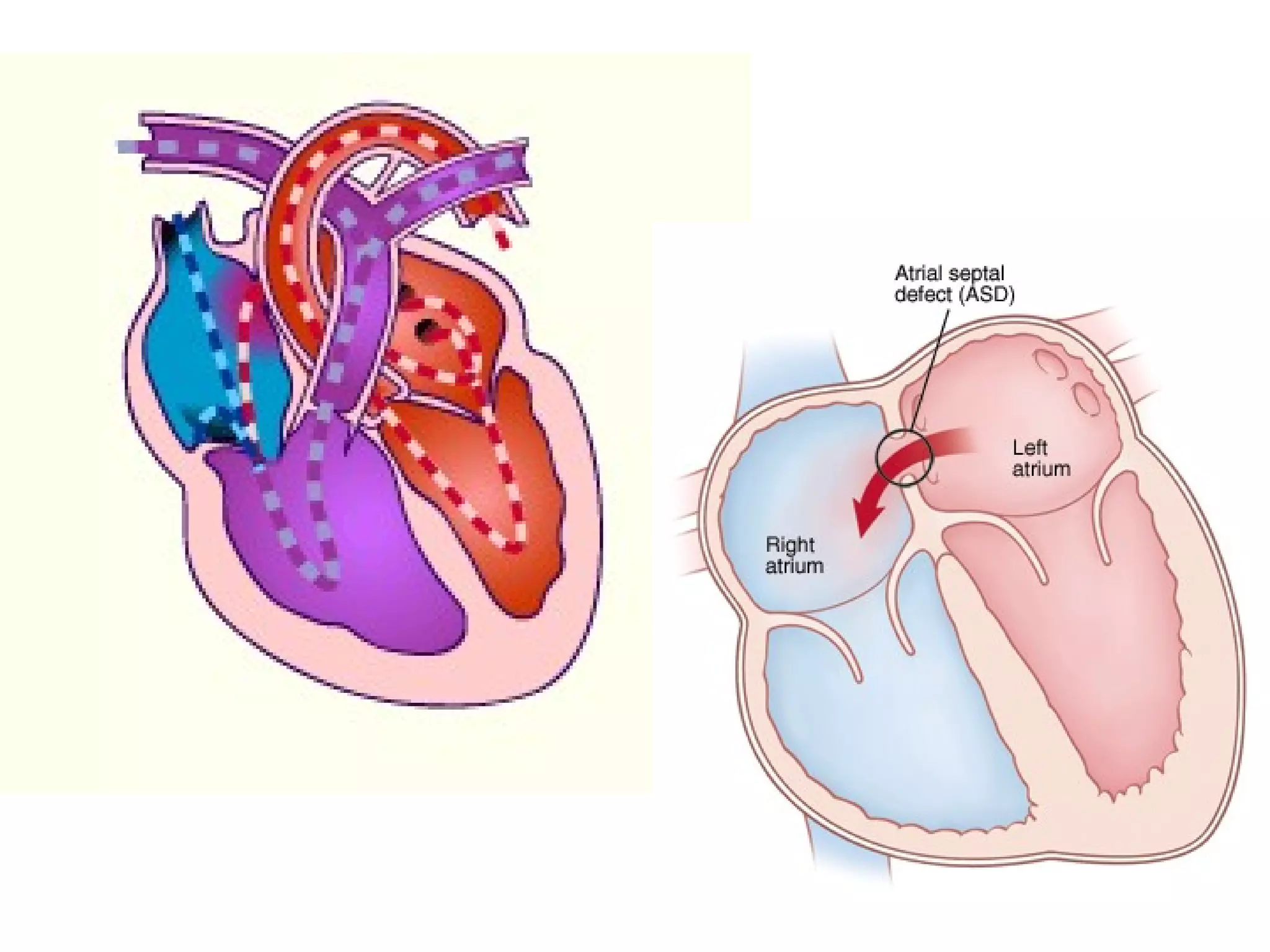 ATRIJALNI SEPTALNIATRIJALNI SEPTALNI
DEFEKT (ASD)DEFEKT (ASD)
 