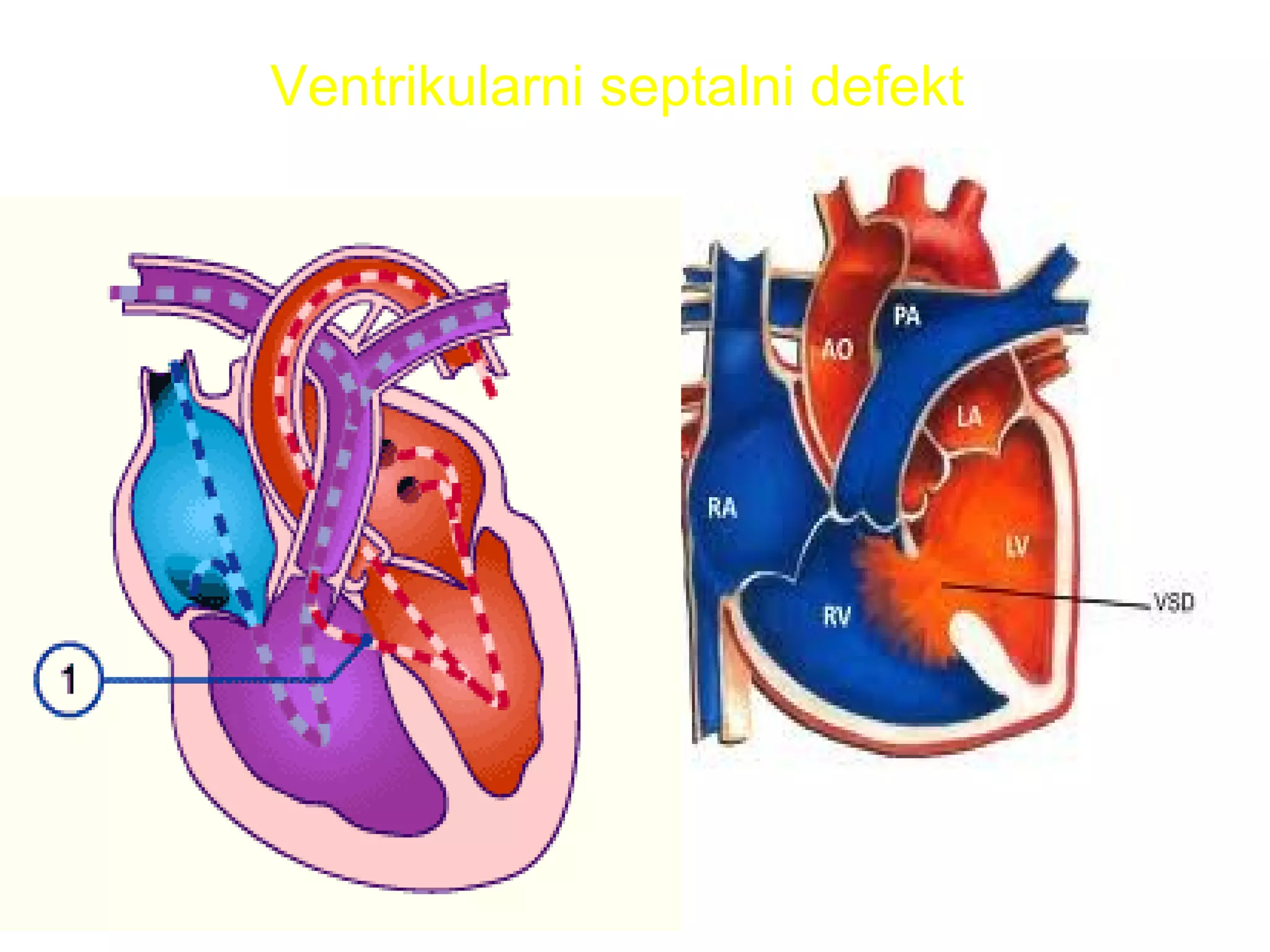 VENTRIKULARNI SEPTALNIVENTRIKULARNI SEPTALNI
DEFEKT(VSD)DEFEKT(VSD)
Ventrikularni septalni defekt
 