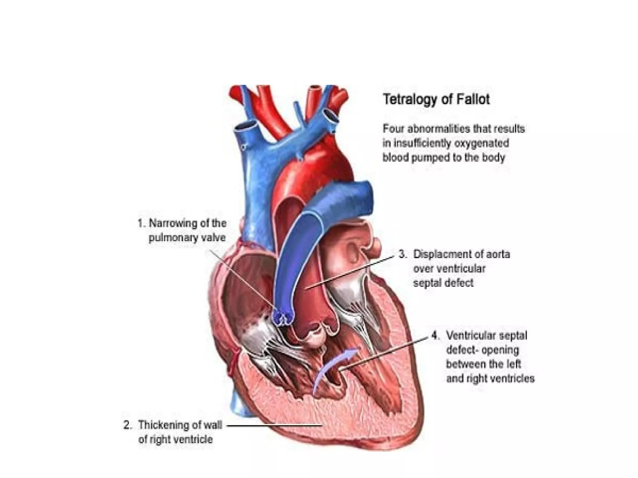 TETRALOGIJA FALLOTTETRALOGIJA FALLOT
 