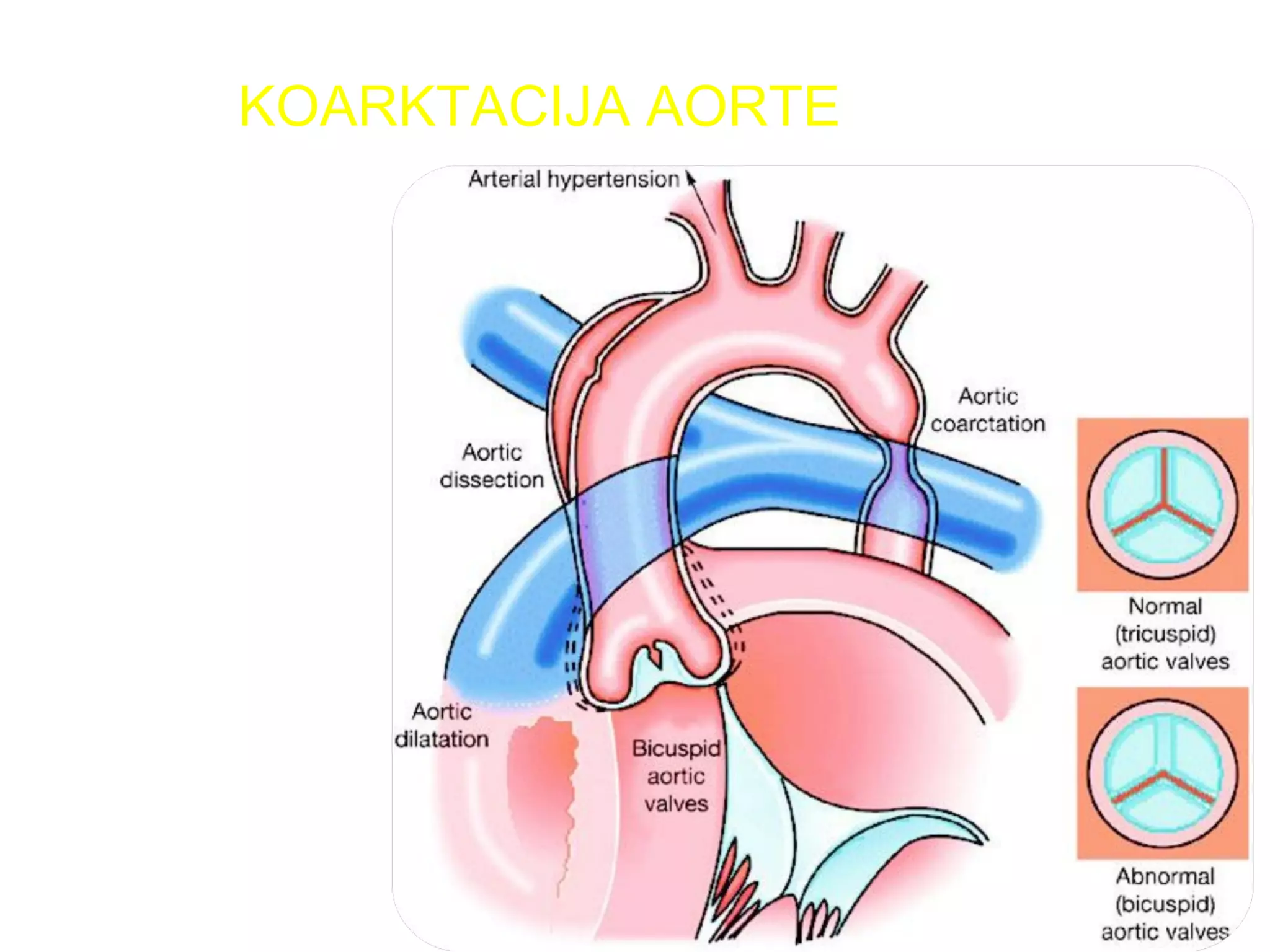 KOARKTACIJA AORTE
 