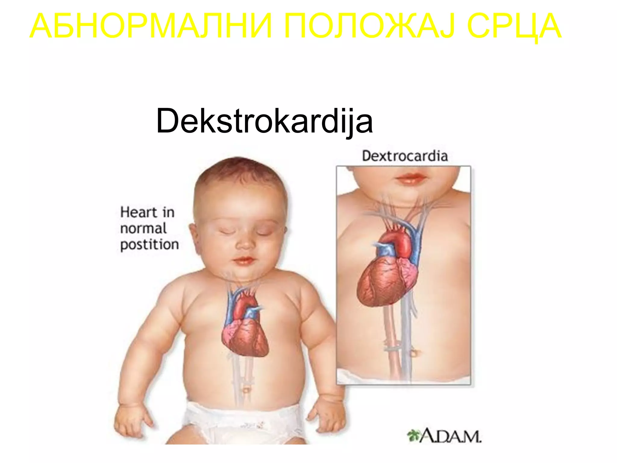 АБНОРМАЛНИ ПОЛОЖАЈ СРЦА
Dekstrokardija
 