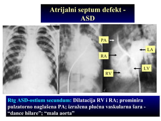Atrijalni septum defekt -
ASD
Rtg ASD-ostium secundum: Dilatacija RV i RA; prominira
pulzatorno naglašena PA; izražena plućna vaskularna šara -
“dance hilare”; “mala aorta”
RV
RA
PA
LV
LA
 