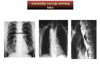 Anomalija razvoja aortnog
luka
Desni aortni luk
 