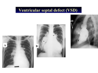Ventricular septal defect (VSD)
RV
VSD
LV
A B
 
