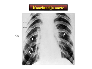Koarktacija aorte
VS
 