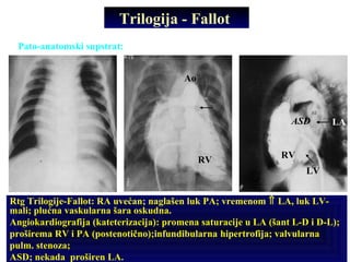 Trilogija - Fallot
Pato-anatomski supstrat: valvularna (ili subvalvularna) stenoza PA; ASD;
hipertrofija VD;
Rtg Trilogije-Fallot: RA uvećan; naglašen luk PA; vremenom ⇑ LA, luk LV-
mali; plućna vaskularna šara oskudna.
Angiokardiografija (kateterizacija): promena saturacije u LA (šant L-D i D-L);
proširema RV i PA (postenotično);infundibularna hipertrofija; valvularna
pulm. stenoza;
ASD; nekada proširen LA.
RVRV
Ao
ASD
LV
LA
 