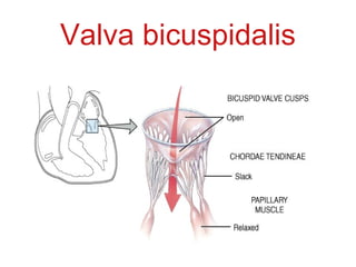 Valva bicuspidalis
 