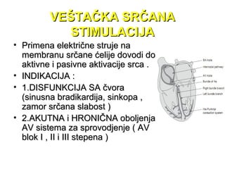VEŠTAČKA SRČANAVEŠTAČKA SRČANA
STIMULACIJASTIMULACIJA
• Primena električne struje naPrimena električne struje na
membranu srčane ćelije dovodi domembranu srčane ćelije dovodi do
aktivne i pasivne aktivacije srca .aktivne i pasivne aktivacije srca .
• INDIKACIJA :INDIKACIJA :
• 1.DISFUNKCIJA SA čvora1.DISFUNKCIJA SA čvora
(sinusna bradikardija, sinkopa ,(sinusna bradikardija, sinkopa ,
zamor srčana slabost )zamor srčana slabost )
• 2.AKUTNA i HRONIČNA oboljenja2.AKUTNA i HRONIČNA oboljenja
AV sistema za sprovodjenje ( AVAV sistema za sprovodjenje ( AV
blok I , II i III stepena )blok I , II i III stepena )
 
