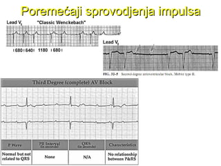 Poremećaji sprovodjenja impulsaPoremećaji sprovodjenja impulsa
 