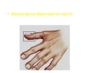 • Маљичасти (Батичасти) прсти
 