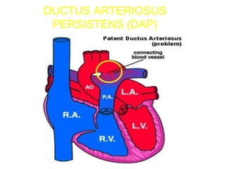 DUCTUS ARTERIOSUS
PERSISTENS (DAP)
 